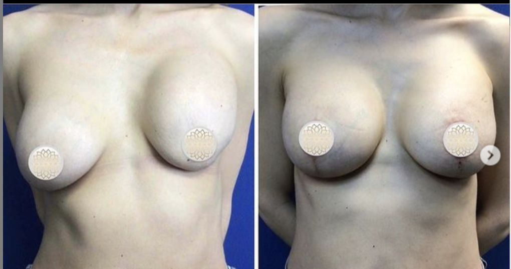 pre and post breast augmentation outcome
