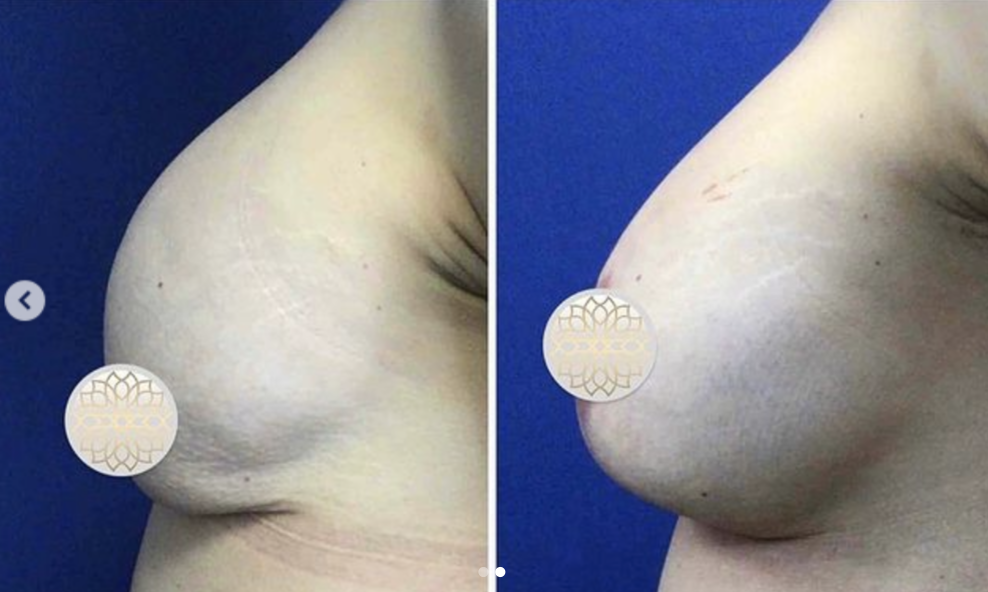 before and post breast augmentation outcome